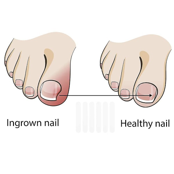 10 stk. Indgroet tånegl Pedicure Værktøj Straightening Clip Buet bøjle