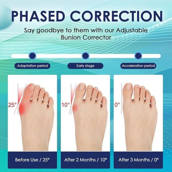 1 par Hallux Valgus-korrigerer, justerbar natt- og dag-tåskiller for hallux valgus-bunion for kvinner og menn