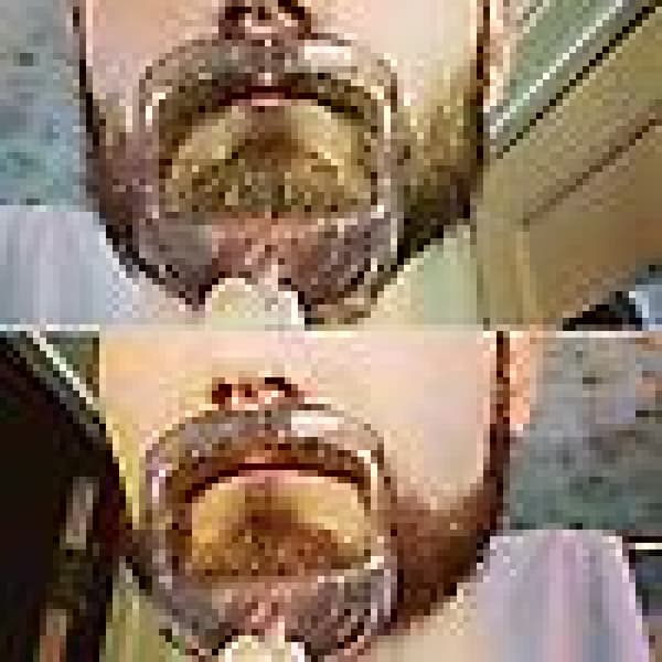 (Vit) 5 størrelser Goatee Barberingsmal Bartguide Shaper Bart S