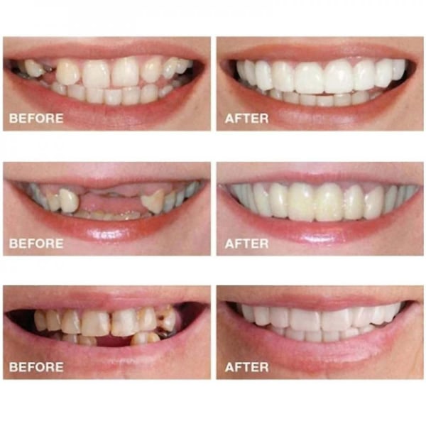 Kosmetisk tandprotesfasader med falska tänder för tandfasader för över- och underkäke för tillfällig tandrestaurering Natur och komfort Lower teeth