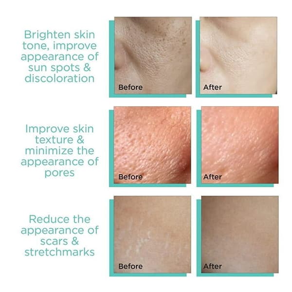 Mikronåle Derma Roller Mikronåle Hudplejeværktøj Mikronåle Roller til mænd og kvinder