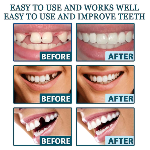 Tandproteser Midlertidige falske tænder til Snap On Instant & Confidence Smile, Tandfiner til midlertidig tandrestaurering 1 par