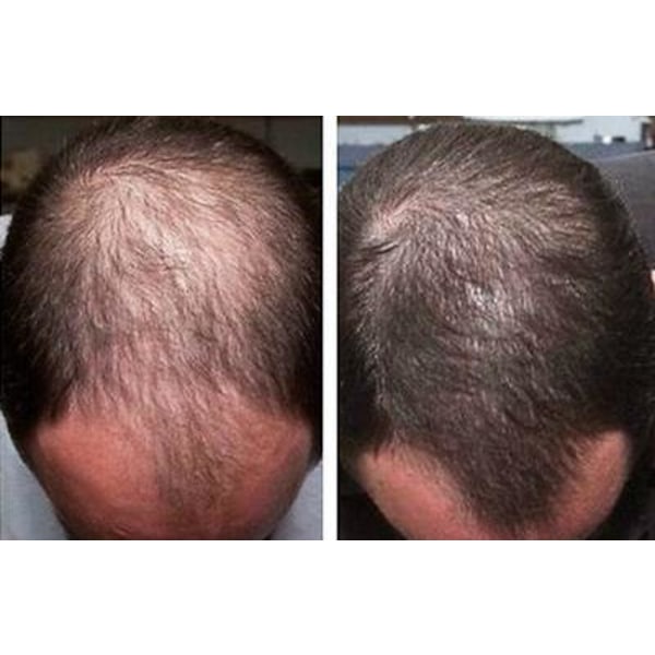 6 st. Foligain Minoxidil 5% Hair Regrowth Treatment Extra Streng