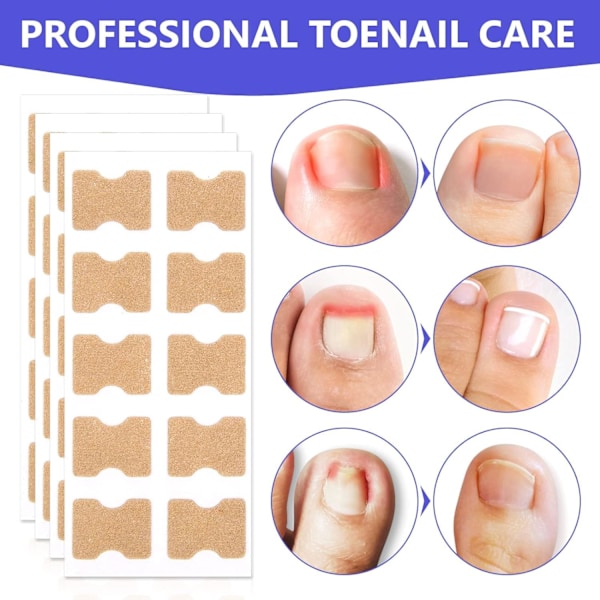Behandling av nageltrång, 100 st andningsbara korrigeringsplåster, smärtfri nagelkorrigering, nageltrångremsor, behandling av nageltrång