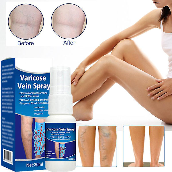 30 ml Åreknude Spray Regnorm Benmassage Spray Hævelse Smertelindring Opstram huden