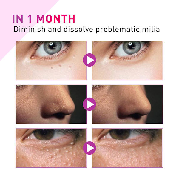 Milia Spot Treatment hjälper till att lösa upp och minska problematisk remover med naturliga ingredienser skonsam null none