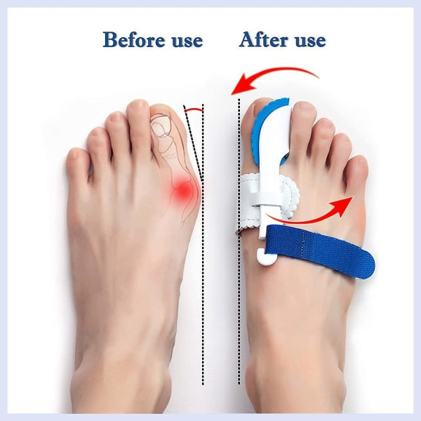 IC Hallux Valgus Korrigering 2 par Hallux Valgus Korrigering Stor tå Justerbar erme for menn og kvinner