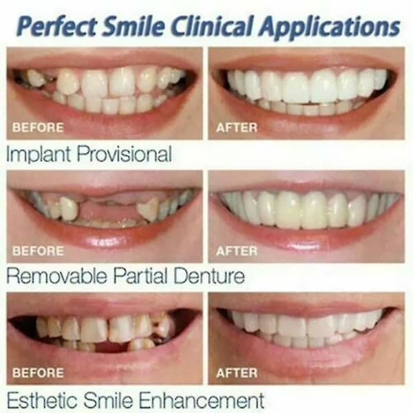 Smile Napsauta irrotettavat hammasproteesit Ala- ja ylähampaiden hammaspeitteet Set Cover null none