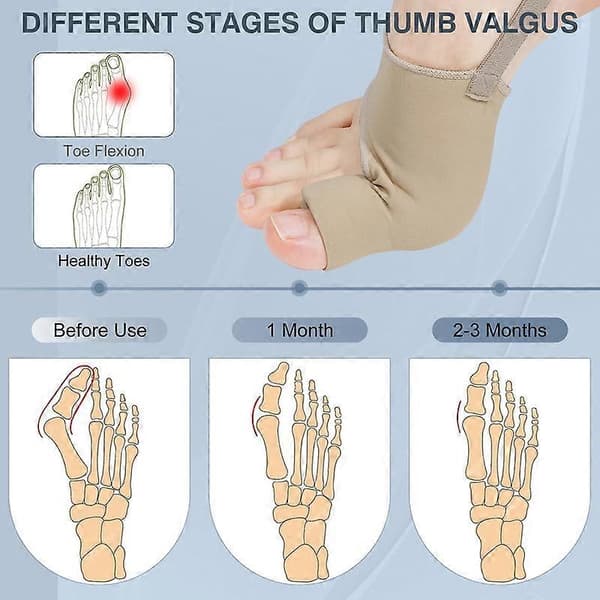 2 stk. Hallux Valgus Korrigerer for Kvinner og Menn, Hallux Valgus Tåkorrigerer
