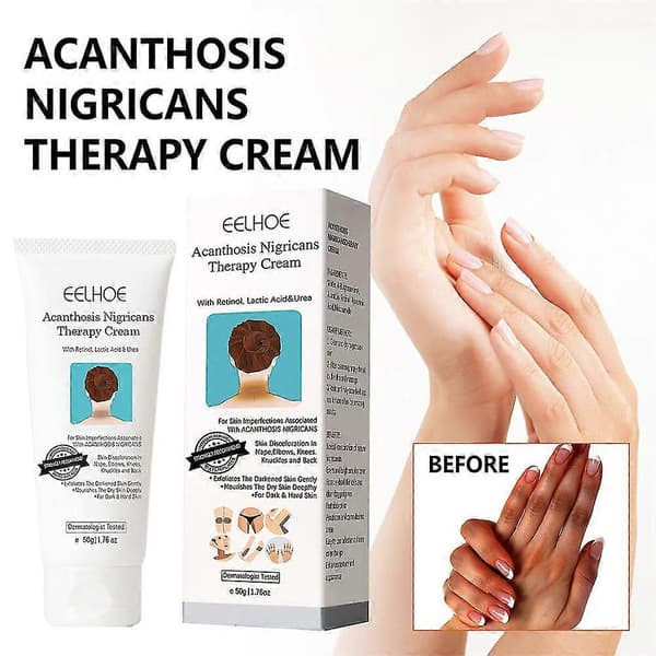 3 stk. Acanthosis Cream Nigrifix Creme til Acanthosis Nigricans Sorte Pletter