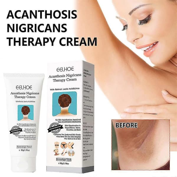 3 stk. Acanthosis Cream Nigrifix Creme til Acanthosis Nigricans Sorte Pletter