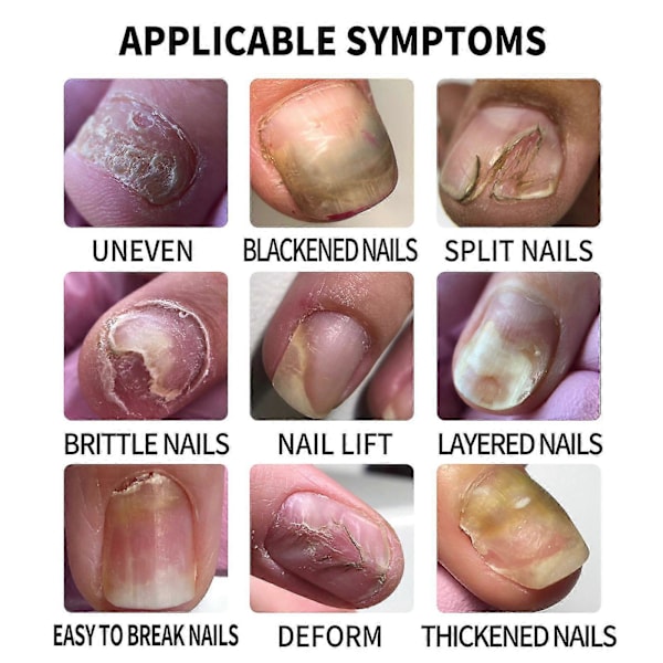 Grå Nagelreparationsvätska Nagelutjämnande Essens Mjuka Naglar Förtjockande Naglar Grå Nagel Uppljusande Nagel