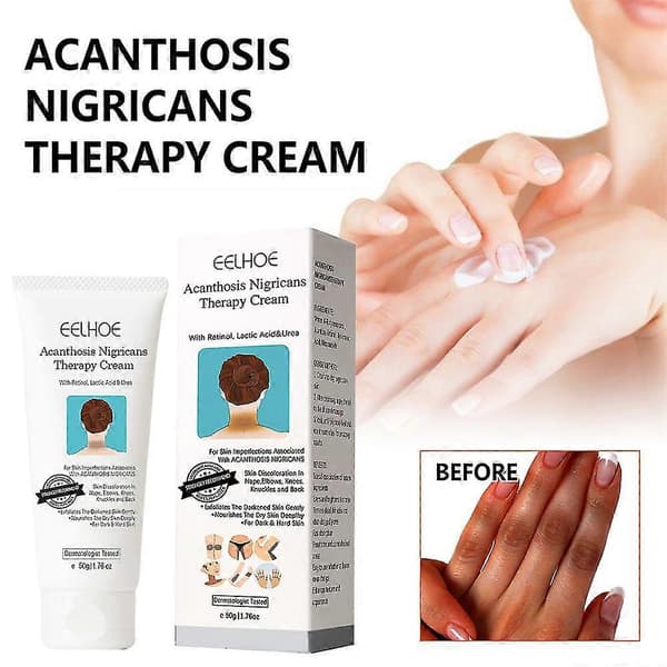 3 stk. Acanthosis Cream Nigrifix Creme til Acanthosis Nigricans Sorte Pletter