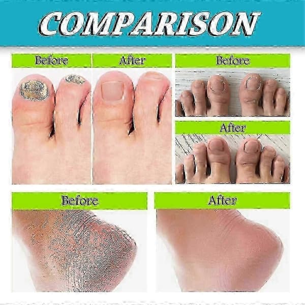Fod- og neglespray mod fodlugt 3pcs