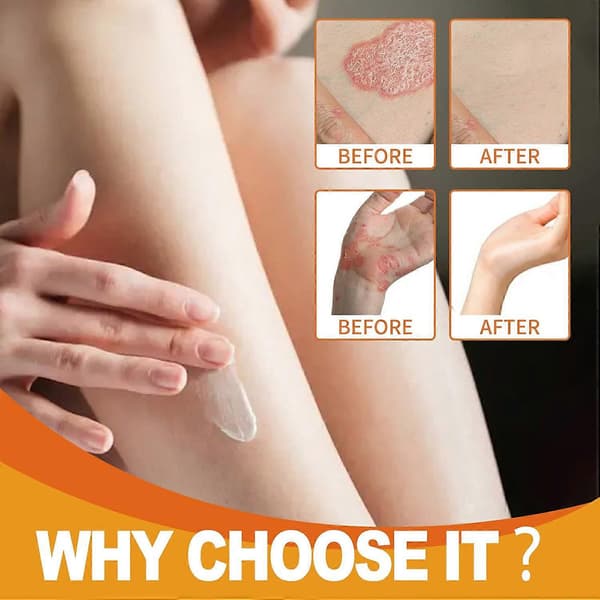 Bivenom Psoriasis Kräm Intensiv Behandlingskräm för Eksem Psoriasis Rosacea Dermatit Bältros R