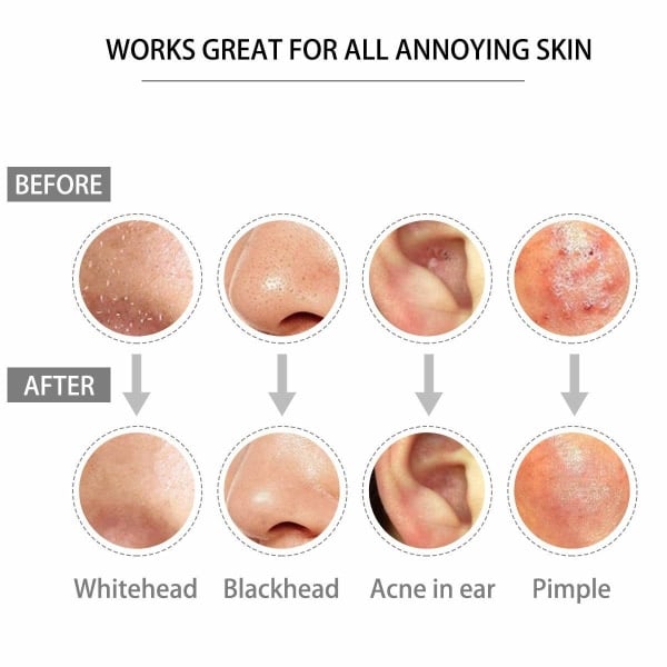 (Spesialkampanje) CQBB Blackhead Remover, Pimple Popper i rustfritt stål