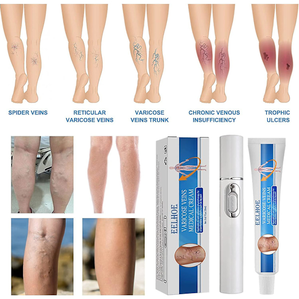 (Specialerbjudande) Veinshealth Åderbråck Blå Ljusterapi Set, behandling av åderbråck Blå Ljus Laser Behandlingspenna, åderbråckskräm 1pen x 1cream