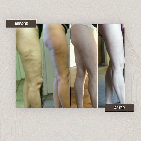 Cellulit Massageverktyg - Djupvävnad och Triggerpunktsmassagepinne - Stöd för obehag och kroppsskulptering
