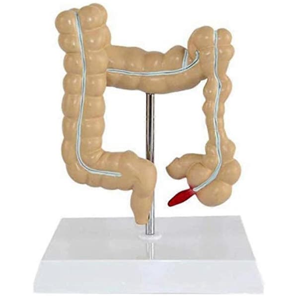Patologisk Kolorektal Model Tyktarmsmodel Gastrointestinal Anatomisk Model