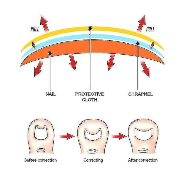 10/50 stk tåneglkorrigeringsplaster Limfri pedikyrværktøj Tåneglkorrigering for indgroede lapper
