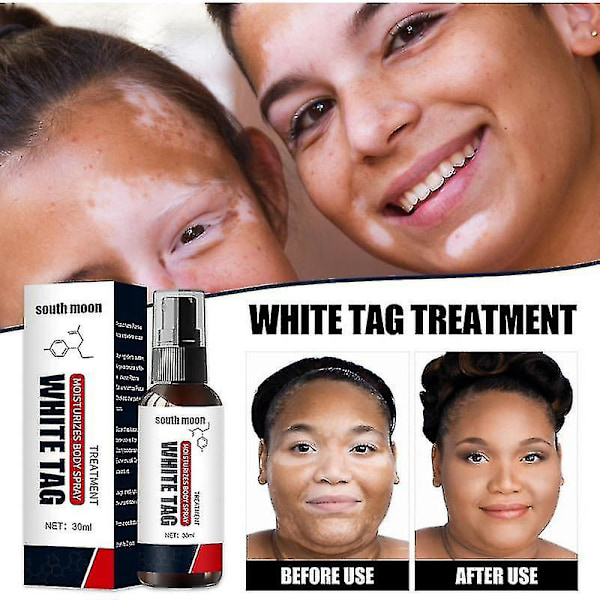 Hvit Flekk Reduserende Spray - Vitiligo Behandling