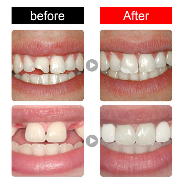 Tandfyllningssats Tandfyllningsreparationssats Temporary Dental Repair Cement Tand Gap Falseteeth Solid Glue Set (FMY)