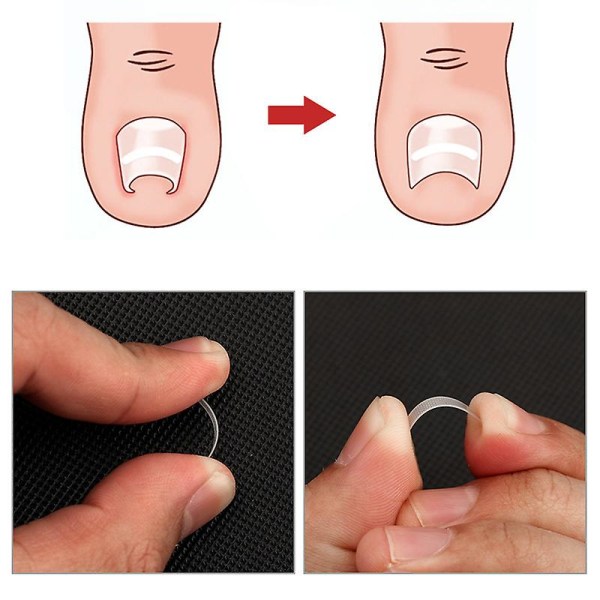 10pcs Ingrown Toenail Pedicure Tool Kit Ingrown Toenail Corrector Strips Professional Toenail Correction Patches  (FMY)