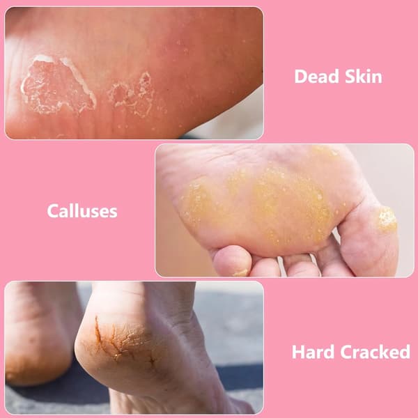 Fodfil til fjernelse af hård hud, pedicure-scrubber i rustfrit stål til hård, revnet, død hud, våd og tør fodpleje, pink