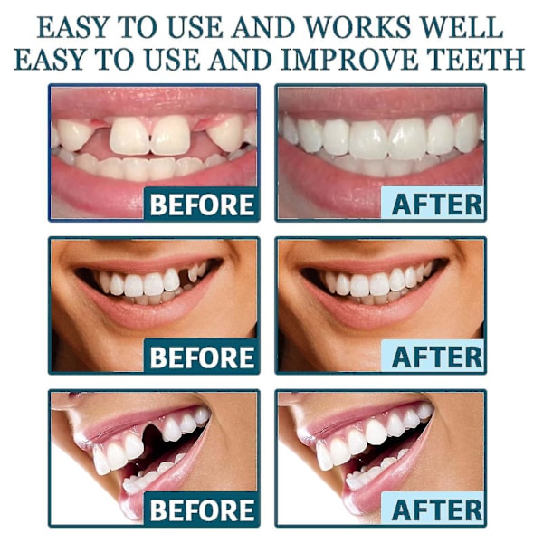 Justerbara Snap-on Proteser, Veneer Proteser Tandställning Plus Proteser Fodral, Tillfälliga Fyllningar Tandställning Interdental Fyllningar Rätande Proteser Kit