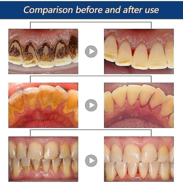 30ml Tandstenopløsende Tandspray Mundrensning Tandstenfjerner