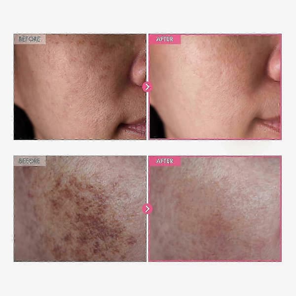 1~5x Arbutin 7% + Tranexamic Acid 4% voide 50g New_jsaf 4PCS