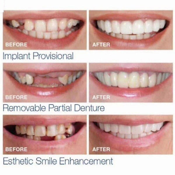 Smile Snap On Falske Tenner Øvre Nedre Dental Veneers Proteser Tann Deksel Sett