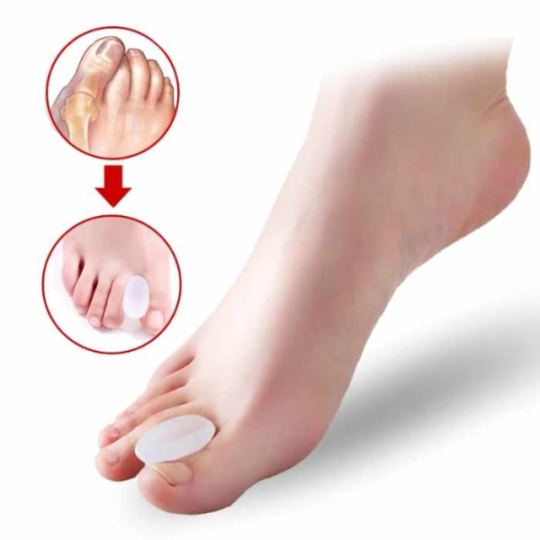 2-Pack - Hallux Valgus Isovarpaan erotin