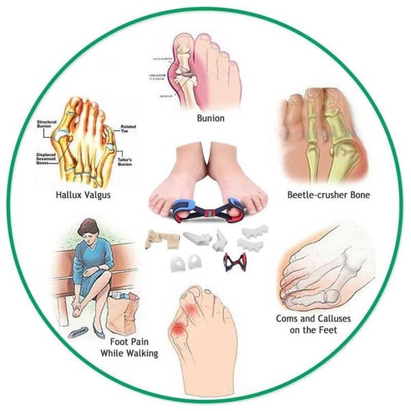 Hallux Valgus - varpaiden korjaussarja 9 kpl