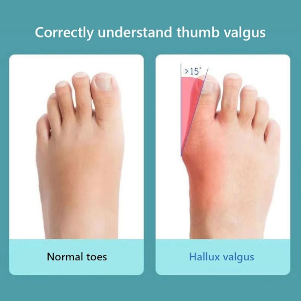 Hallux Valgus Korrigerare, Stortåseparator med Justerbart Band, Mjuk Gel Bunion Splint för Smärtlindring och Icke-Kirurgisk Hallux Valgus