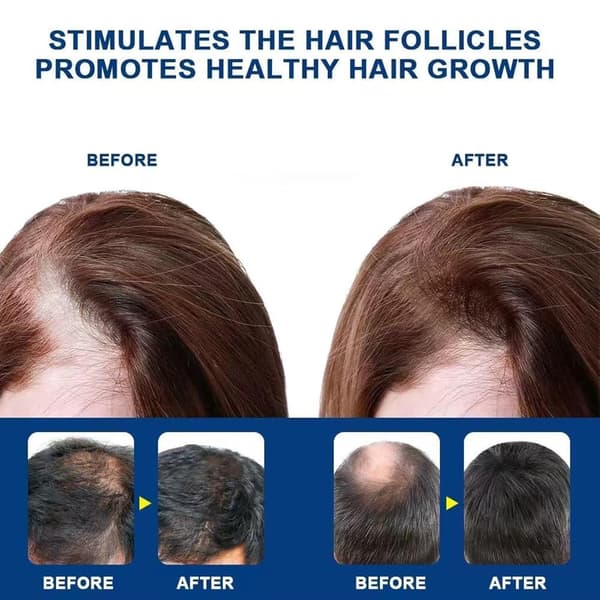 Alopesian hiustenkasvuvoide