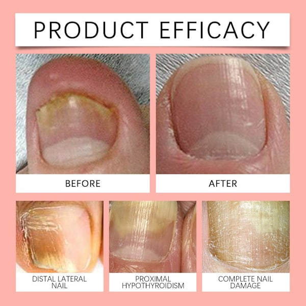 Svamp Nagelplåster Nagelreparation Enkel Effektiv Nagelbehandling - FRI FRAKT