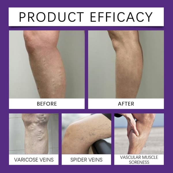 DiaLeg Care Cream, Avancerad Multi-Ceramid Nattkräm, Åderbråckskräm
