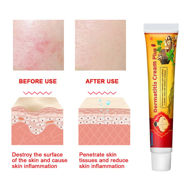 Dermatitis Cream Plus ihonhoitovoide K10175 20g - Dermatitis Cream Plus