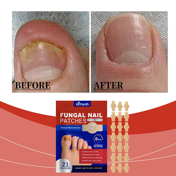 Svamp Nagelplåster Nagelreparation Enkel Effektiv Nagelbehandling - FRI FRAKT