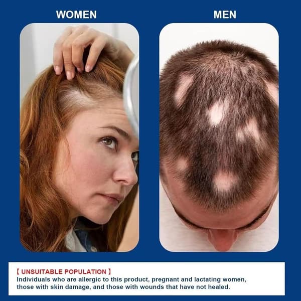 Alopecia Hårvækstcreme