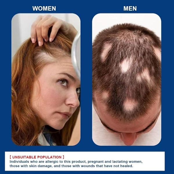 Alopecia Hårväxtkräm