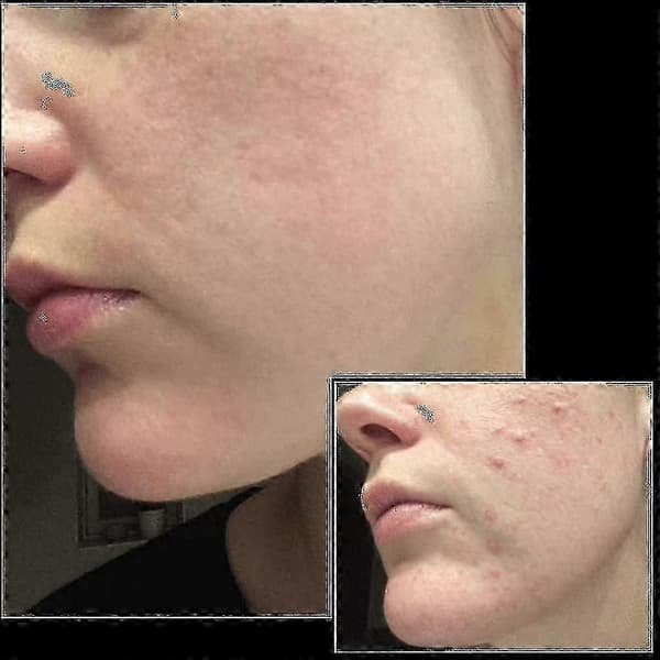 Dermastamp säädettävällä mikroneulalla ihonhoitoon
