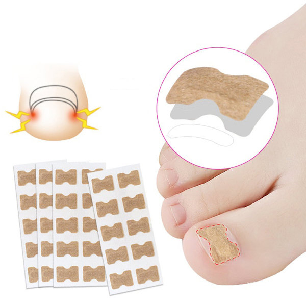 100 st Ingrown tånagel korrigering klistermärken med dubbelsidig tejp Paronychia korrigering pedikyr verktyg