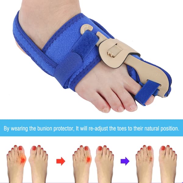 1 par kvindelige tåskillere Hallux Valgus knystkorrigerer kan bære sko
