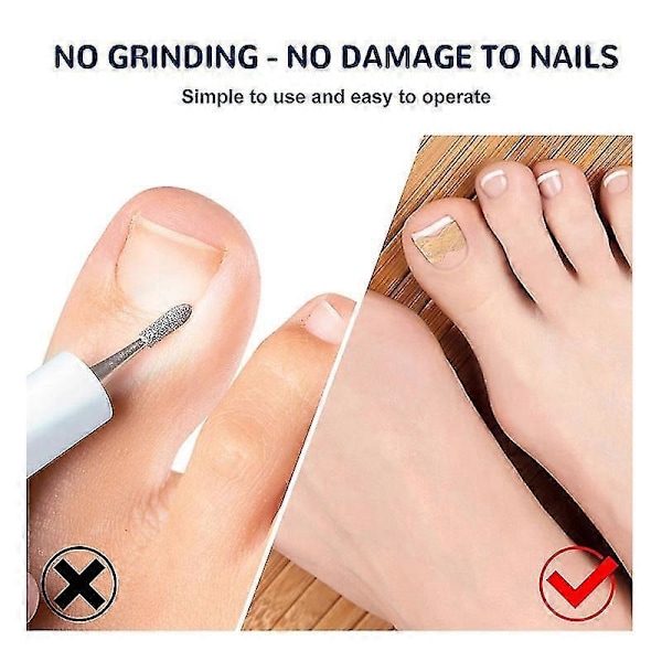 Paronychia Behandling Nagelkorrigeringsstickers - 100st