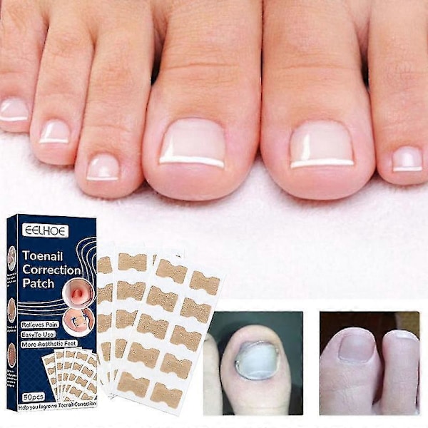 Paronychia Behandling Nagelkorrigeringsstickers - 100st