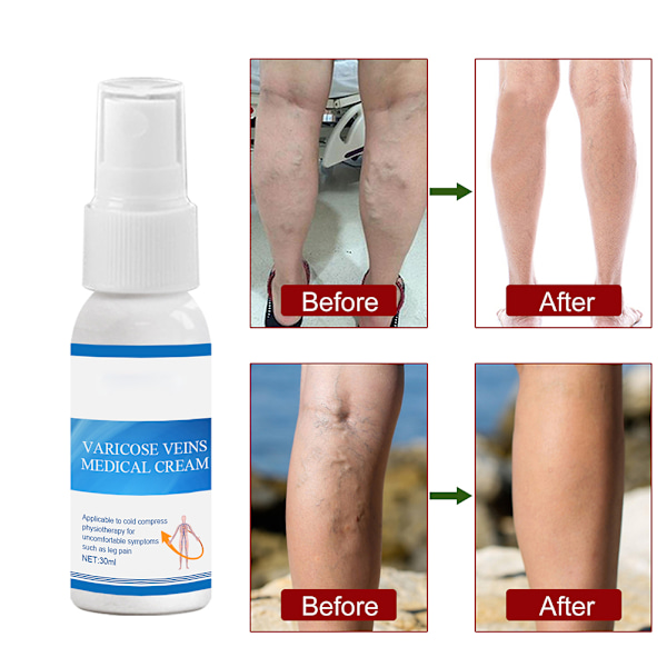 Åreknudespray Antiinflammatorisk Effektiv Åreknudespray