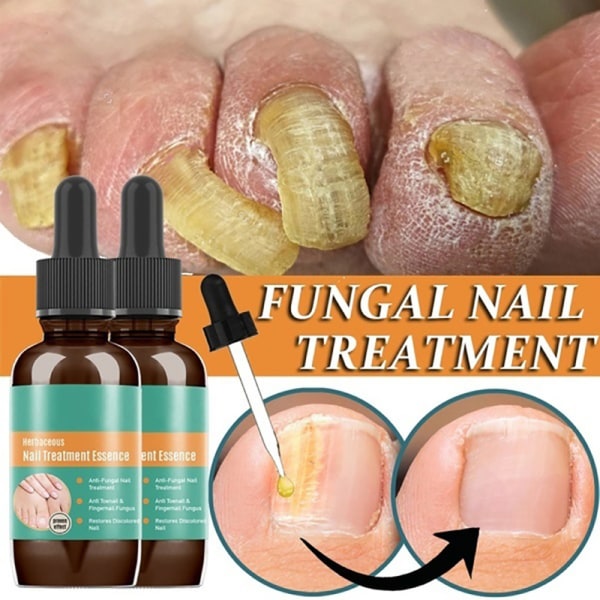 30ml Nail Fungal Liquid Anti Fungal Nail Solution til finger- og tånegle