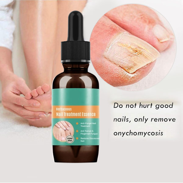 30ml Nail Fungal Liquid Anti Fungal Nail Solution for finger- og tånegler